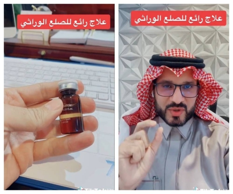 وداعاً للإحراج ..طبيب سعودي يكشف عن أحدث علاج متوفر ومرخص في المملكة لعلاج الصلع الوراثي للرجال والنساء (فيديو)